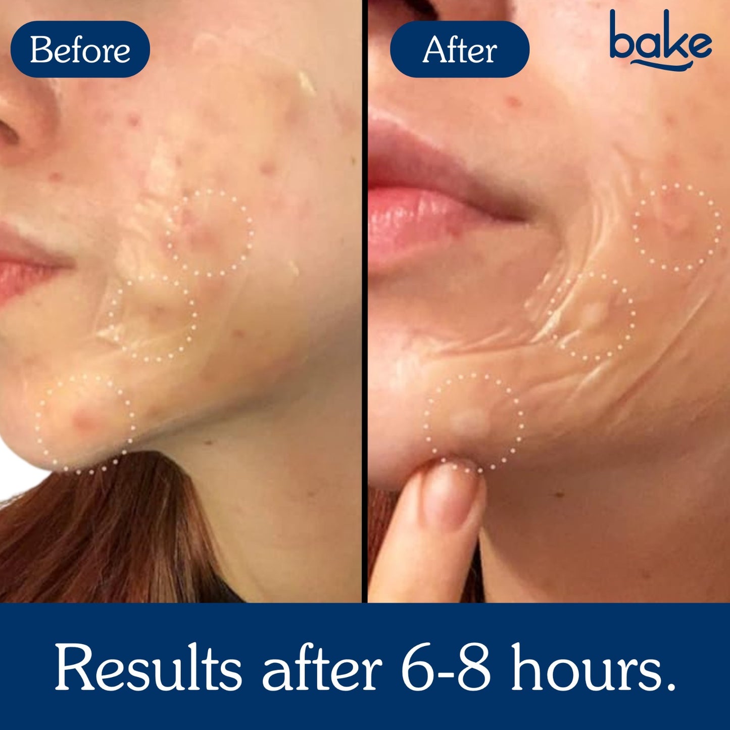 Acne Erase XL Pimple Patches - 10 Strips